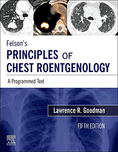 Felsons principles-of chest roentgenology