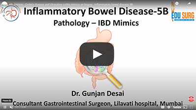 IBD mimics - Crohn's disease and Ulcerative colitis mimics on biopsy - Inflammatory bowel disease