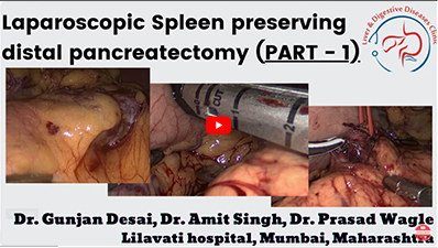 Laparoscopic pancreatic tumor surgery