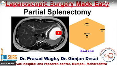 Spleen removal surgery